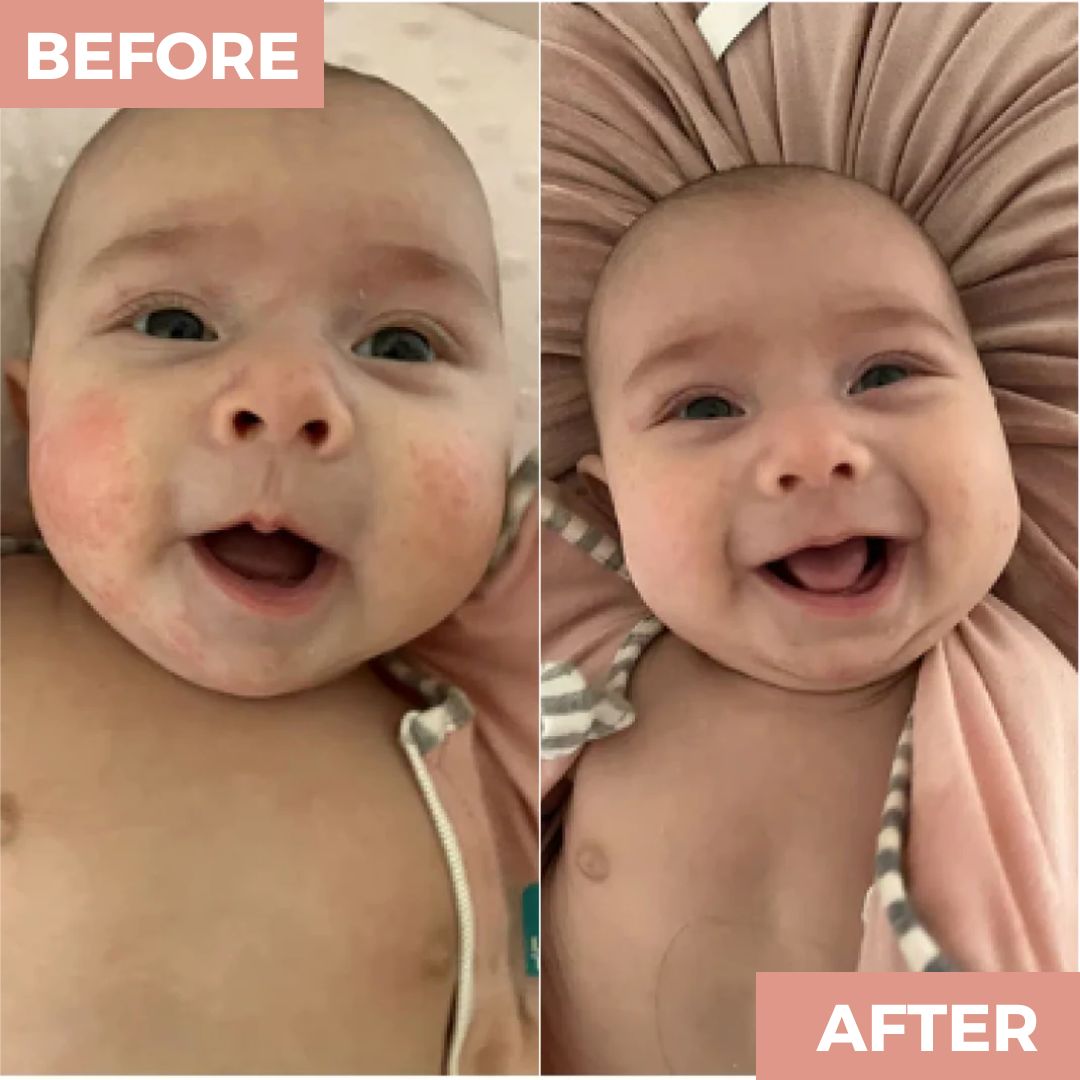 The Powder That Finally Helped My Daughter’s Eczema