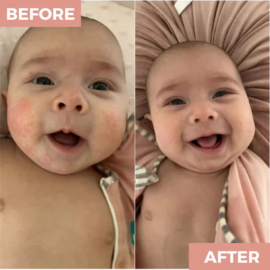 The Powder That Finally Helped My Daughter’s Eczema